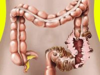 مشکلات دیورتیکولیت در روده بزرگ