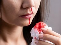 چه زمانی خونریزی بینی نگران کننده است؟