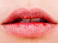 خشکی دهان نشانه کدام بیماری است؟