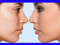 راهکارهای محو  بقایای جوش‌ها!