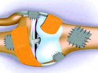 عوامل بروز پوکی استخوان