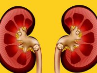 نسخه تغذیه برای  بیماران کلیوی