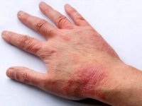 پیشگیری و درمان آلرژی درماتیت تماسی