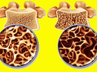 پوکی استخوان