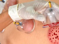 حجامت در فصل پاییز چه شرایطی را دارد؟