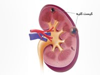 آشنایی با علائم بیماری کلیه پلی کیستیک + اینفوگرافیک