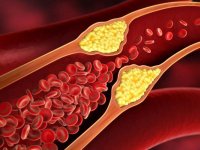 ۶ نشانه خطرناک گرفتگی رگ‌ها