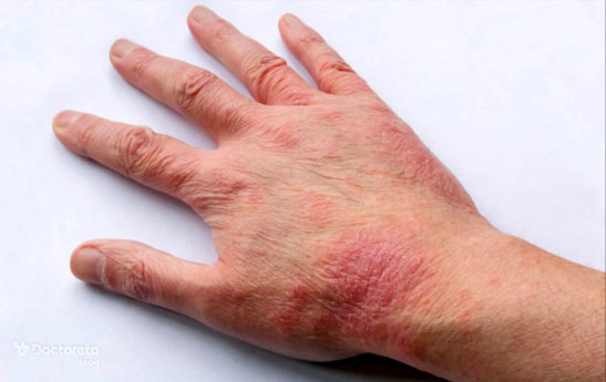 پیشگیری و درمان آلرژی درماتیت تماسی