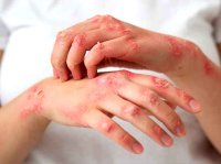چرا برخی افراد بطور مکرر دچار اگزما می‌شوند؟