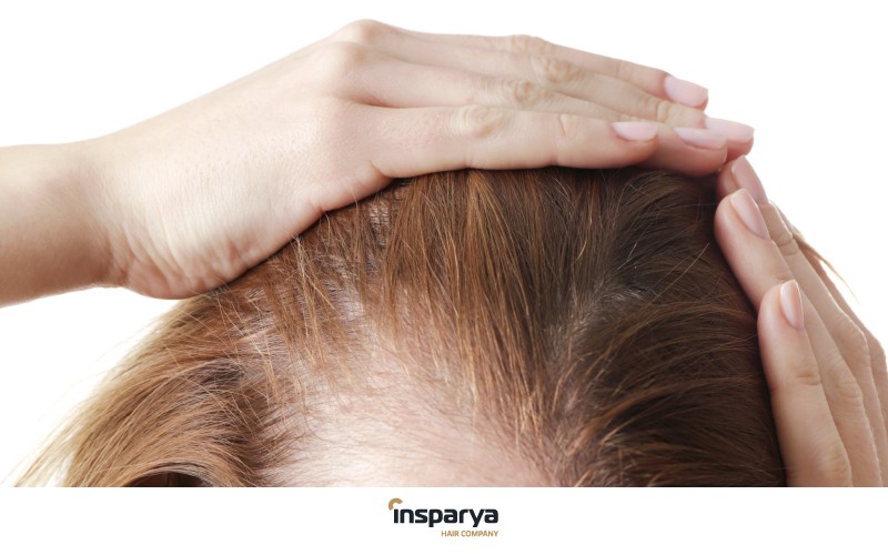 بهترین روش‌های درمان ریزش مو خانم ها
