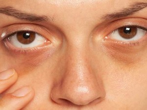 چگونه تیرگی زیر چشم را برطرف کنیم؟