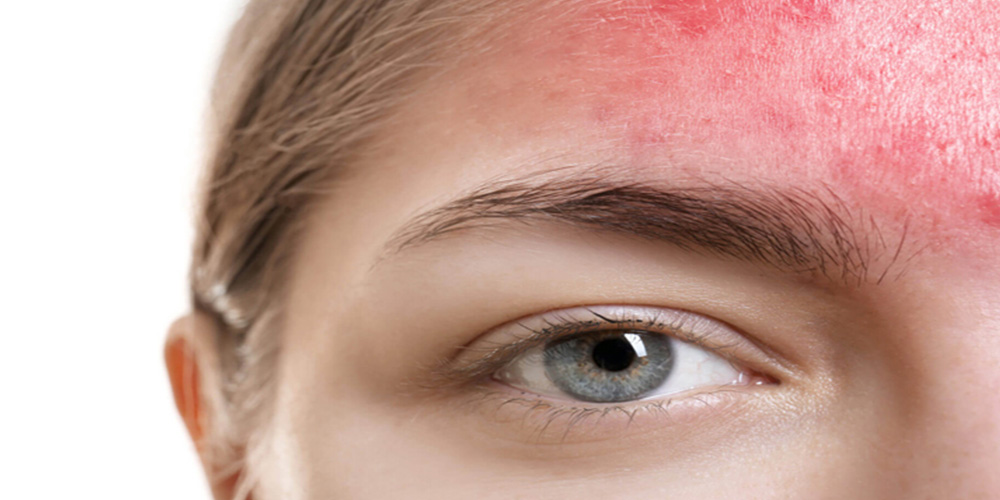 التهاب پوست